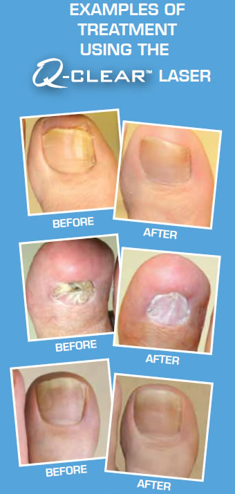 Q-Clear Laser Treatment for Fungal Toenails 